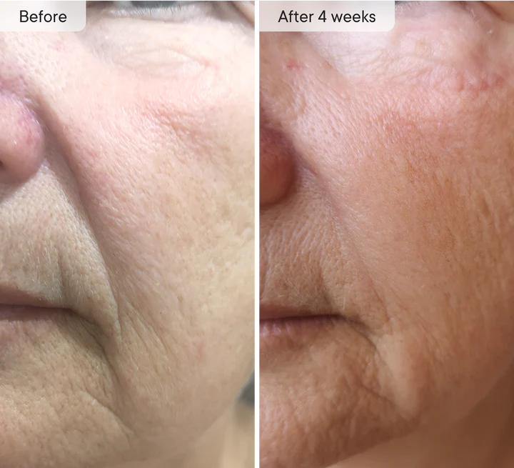 DermaFlect™ Microneedle Under-Eye Patches