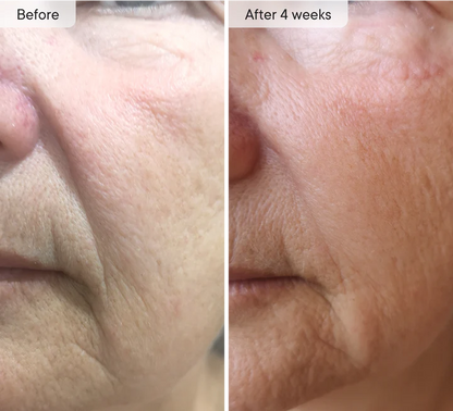DermaFlect™ Microneedle Under-Eye Patches