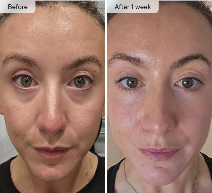 DermaFlect™ Microneedle Under-Eye Patches