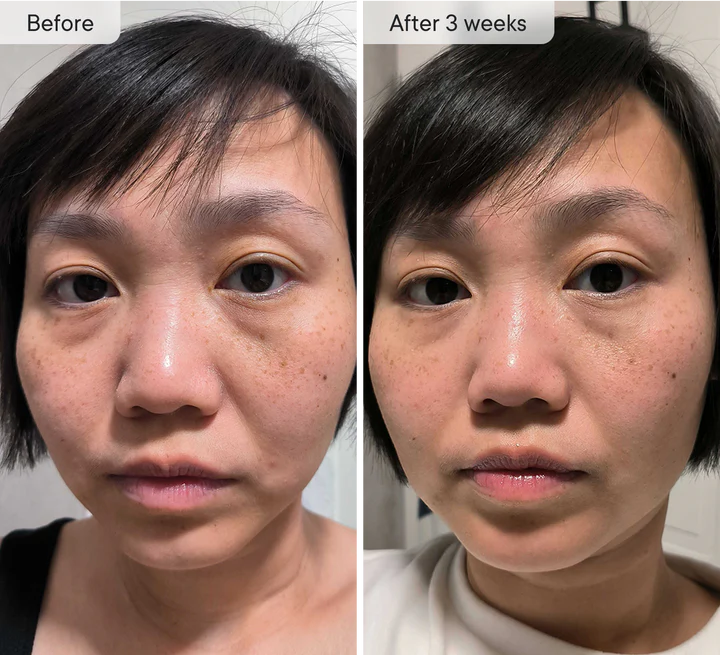 DermaFlect™ Microneedle Under-Eye Patches