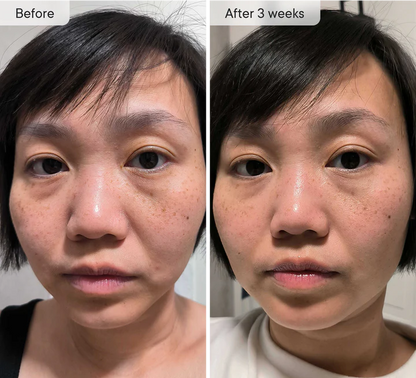 DermaFlect™ Microneedle Under-Eye Patches